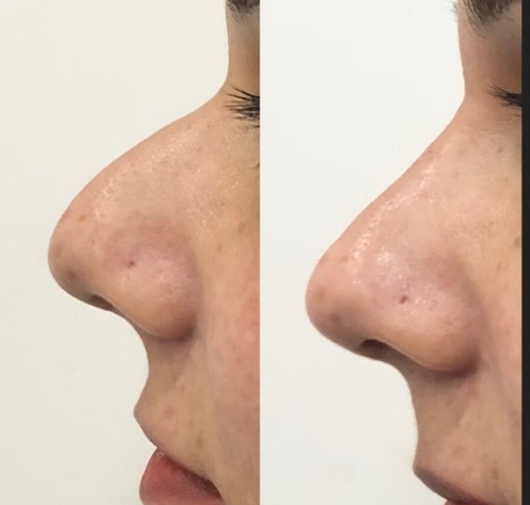 Rhinoplasty  after before