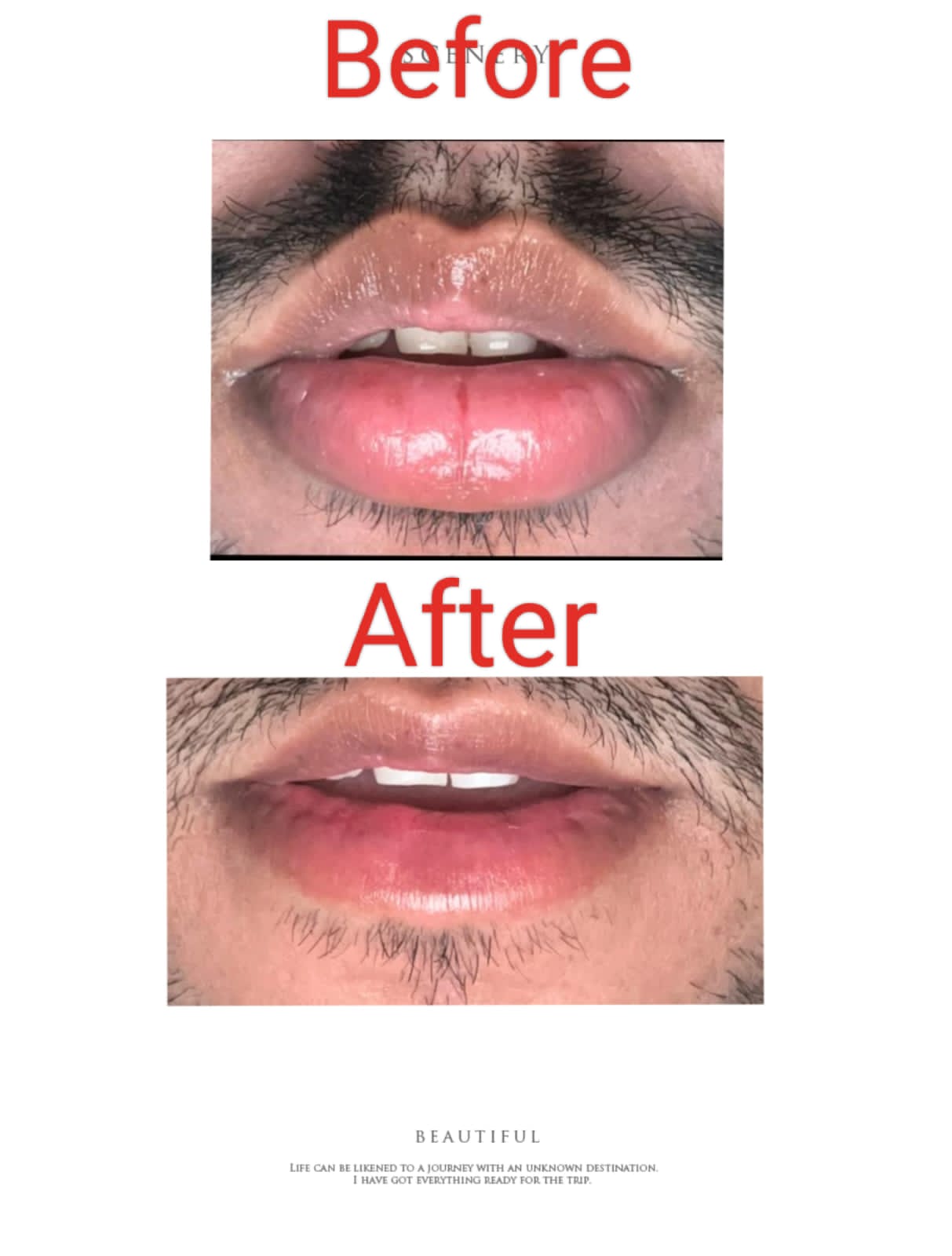 Lower lip Reduction surgery